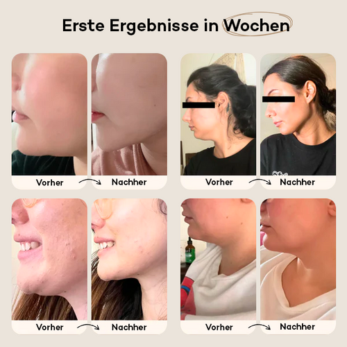 SculplinePro V-Lift ™